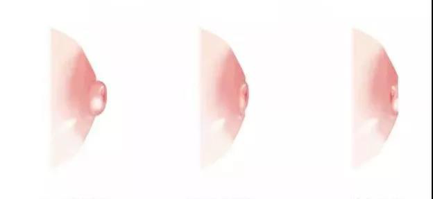 成都乳头凹陷 成都乳头凹陷